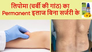 Lipoma चर्बी की गांठ  का कारण लक्षण और सबसे अच्छी होम्योपैथिक दवा  Cure Lipoma with homeopathy [upl. by Ramu]