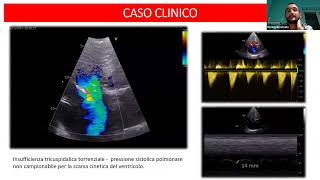 La valutazione ecocardiografica del cuore destro [upl. by Adneral272]