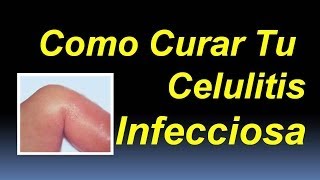 Celulitis Infecciosa  Como curar la celulitis infecciosa [upl. by Ott]