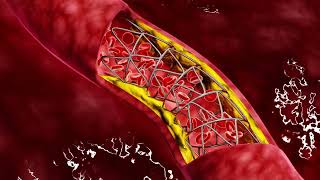 Carotid Artery Disease CAD [upl. by Bigner]