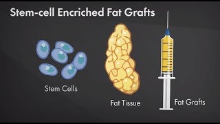 Is Fat Grafting Safe After Breast Cancer Plastic Surgery Hot Topics with Rod J Rohrich MD [upl. by Medarda]