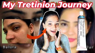 How RetinolTretinoin Transformed my Skin in just 2 Months A MustSee Indian YouTuber Anmol [upl. by Wain]