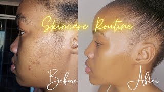 My skincare routine for acne  Under R50  South African YouTuber [upl. by Sato]