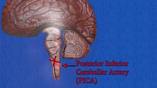 Wallenberg syndrome  Lateral medullary syndrome  posterior inferior cerebellar artery syndrome [upl. by Eivlys]