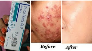 इससे होंगे पिंपल्स खत्म  Clear Acne Pimples once and for all  best solution for acne RabiaSkincare [upl. by Vikky]