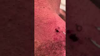 Monster ingrown hair finally out after 10 years [upl. by Bull]