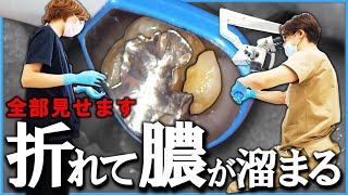 【 急患 】歯が折れたら、膿が溜まったら『 即抜歯 』！？ 30分ノーカット 実際の治療の様子 ＃膿 ＃歯が折れる ＃根管治療 ＃根尖病巣 ＃歯医者 [upl. by Malonis]