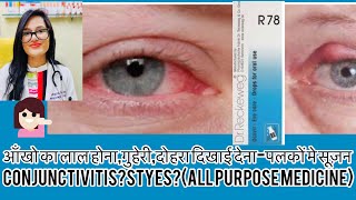 गुहेरीआँख का लाल रहनाStyeBlepharitishomeopathy for eye Problems Conjunctivitis  DrRukmani [upl. by Fusco]