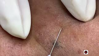 Big Cystic Acne Blackheads Extraction Blackheads amp Milia Whiteheads Removal Pimple Popping [upl. by Nnylecoj]