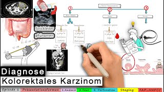 kolorektales Karzinom Ep 13 DIAGNOSE [upl. by Zsa340]