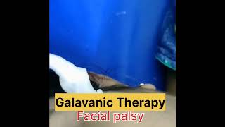 Facial nerve palsy [upl. by Yniattirb]