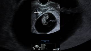 8 weeks fetus subchorionic hemorrhage peri sac hematoma ultrasound ardms sonography radiology [upl. by Assiralc]