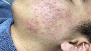 ACNE TREATMENT VU QUYNH MI Acne On Teens Cheek 2024 [upl. by Dwane]