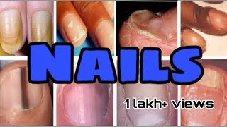 Nails disorders  Nails diseases and differential diagnosis  MisMedicine [upl. by Adnirual489]