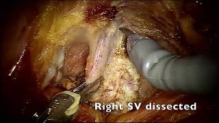 Nerve sparing Robotic Assisted Radical Prostatectomy final Full video [upl. by Enomad457]