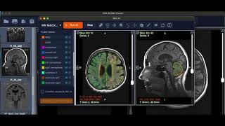 Automated Brain Measurements with AI  IMV Subcortical [upl. by Karl]