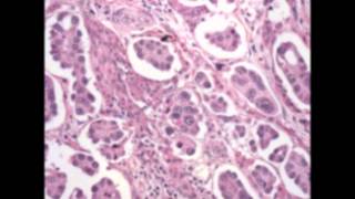 Bladder pathology  topic 6 Urothelial Carcinoma and Its Variant [upl. by Henderson689]