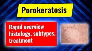 Porokeratosis overview clinical subtypes histology treatment options Dermatology review series [upl. by Savvas]