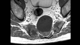 Sacral Chordoma [upl. by Fai543]