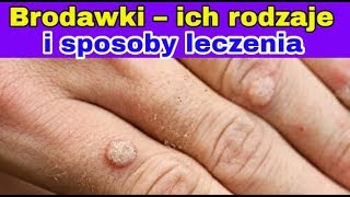 Brodawki – ich rodzaje i sposoby leczenia [upl. by Irina]