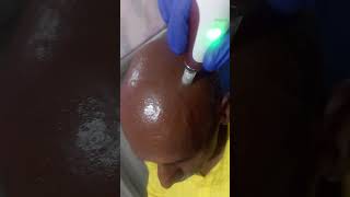 Dermapen for bald to bold hair growth treatment [upl. by Airda]