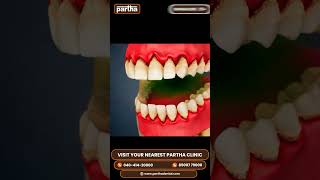 Periodontics Treatment at Partha Dental  Expert Care for Your Gums [upl. by Acirt]