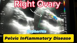 Pelvic Inflammatory Disease Scan  Oophoritis  Inflamed Ovaries  Acute Pelvic Pain  Urdu  Hindi [upl. by Euqinay]