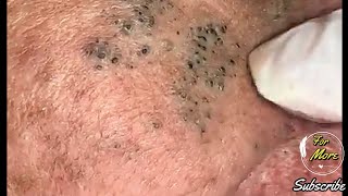 Dr Pop  Deep Blackheads in old Skin removing amp treatment 2020 Part 4 HD [upl. by Posehn786]