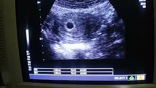 How to find gestational sac with TAS ultrasound at 4 weeks by Dr Fatima [upl. by Fanchon]