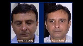 How Thread Face Lift Procedure helps to Remove Wrinkles amp Lines by Dr Debraj Shome [upl. by Efioa]