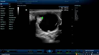 Large Thyroid colloid nodule Diagnostic ultrasound cases [upl. by Nalac]