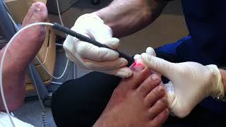 Example of PinPointe FootLaser being used on a Fungal Toenail [upl. by Tedmann84]