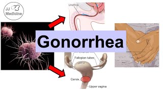 Gonorrhea Neisseria Gonorrhea  Pathophysiology Symptoms amp Complications Diagnosis Treatment [upl. by Boone]