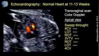 Fetal heart at 12 week 31 clips of the fetal echo compilation [upl. by Toblat931]