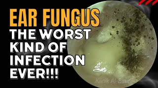 EAR FUNGUS  The Worst Kind Of Infection EVER [upl. by Atews125]