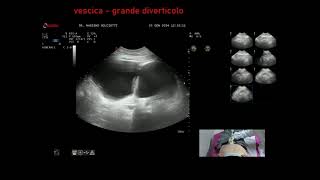 grande diverticolo della vescica [upl. by Araet]