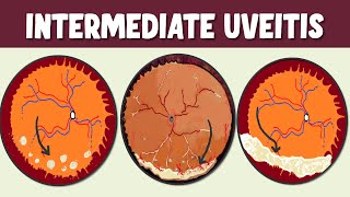 Intermediate Uveitis Spotlight on Symptoms Signs and Potential Complications [upl. by Kristal553]