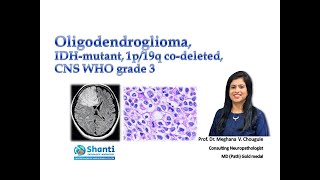 Oligodendroglioma IDH1mutant 1p19q codeleted [upl. by Hadnama]