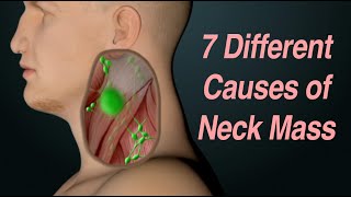 Adult Neck Mass 7 Different Causes Based on Location [upl. by Eednarb]