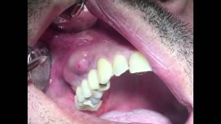 Dental Abscess Drainage by Dentist [upl. by Nitaf305]