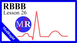 Right Bundle Branch Block RBBB [upl. by Helbona]