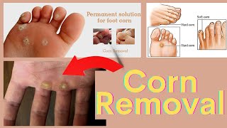 Corn Removal Treatment on the Hand amp foot  Corn Removal by Laser [upl. by Heriberto]