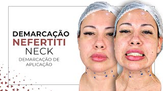 Demarcação Nefertiti Neck  Demarcação de pescoço  Região Pescoço  Botox  Pescoço Sem RUGAS [upl. by Whelan]