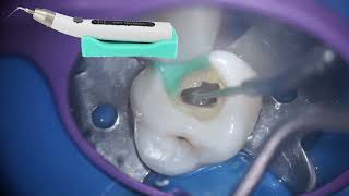 Managing a Calcified Maxillary Molar with ultrasonics [upl. by Laikeze]