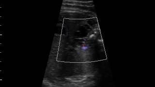 Lymphangiome thoraco abdominal [upl. by Mayfield]