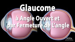 Pathologie du Glaucome Animation [upl. by Esela]