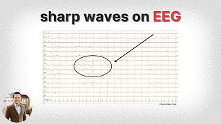 Learn EEG Positive Spikes and Sharps [upl. by Wenger]