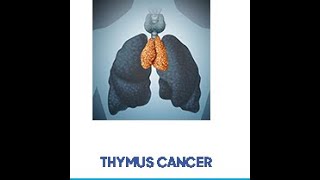 thymoma with pleural mets [upl. by Aiyot]