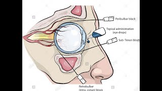 Peribulbar and retrobulbar Block for eye surgery [upl. by Adeuga]