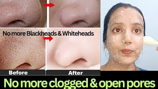 Clogged Pores Blackheads whiteheads जड़ से ख़त्म100 रामबाण इलाज [upl. by Anerahs387]